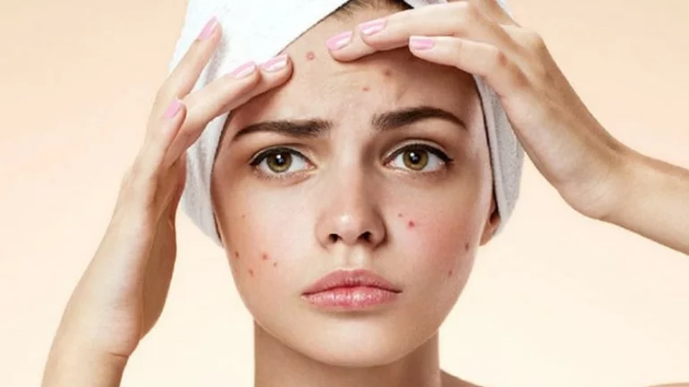 Sağlam qidalanma ilə sızanaqlardan qurtulmaq